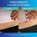ScarAway Advanced Clear Silicone Scar Sheets, Medical Grade Silicone Strips (1.5" x 3") Scar Treatment and Prevention for Surgical, Burn, Body, Hypertrophic & Keloid Scar Treatment, 6 Clear Sheets