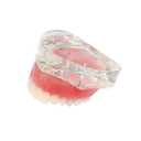 Dental Model Overdenture Inferior 2 Implants Demo Mandibular Model for Education and Study(Upper Jaw)