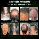 Minoxidil Spray Kit for Men and Women 5% Minoxidil Hair & Beard Growth Oil Kit, Advanced Hair Regrowth Serum Topical Solution Minoxidil Spray Treatment for Hair Loss, Thinning, Hair Thicker 2.02 fl.oz