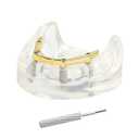 Dental Overdenture Inferior Model 4 Implants Removable Demo Model | For Dentist Education and Study