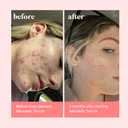 Mandelic Acid Serum Toner Exfoliant | Great For Acne Breakouts, Reduce Redness, Balancing Treatment | Plus Niacinamide, Licorice Root & Hyaluronic Acid, Hydration (Lissy Skincare)