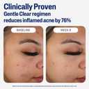 Cetaphil Face Moisturizer, Gentle Clear Mattifying Acne Moisturizer With 0.5% Salicylic Acid, Hydrates and Treats Sensitive Acne Prone Skin, Skin Care for Sensitive Skin, 3oz