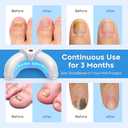 Toenail Fungus Device for Multiple Toenails & fingernails, Nail Fungus Device, Nail Repair Solution for Damaged and Discolored Nails, Suitable for Home Use White