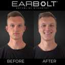 EARBOLT - Ear Pinning Adhesives | Cosmetic Ear Correctors, Pack of 20