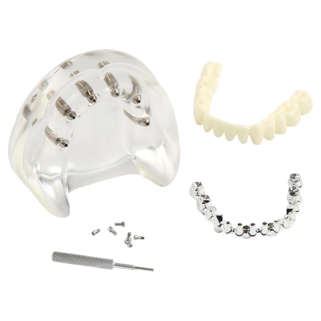 Dental Implant Model Transparent Upper Jaw with 6 Implants and Removable Screws for Overdenture Restoration Dental School Teaching Lab Demo and Patient Education