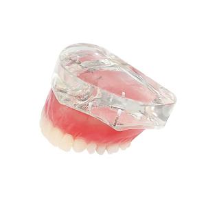 Dental Model Overdenture Inferior 2 Implants Demo Mandibular Model for Education and Study(Upper Jaw)