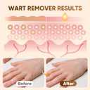 6 x "STAY STOKED" Wart Remover, 15ml Fast-Acting Wart Freeze Off with Natural Herbal Extracts - Gentle Yet Powerful for Common Warts, Plantar Warts on Hands/Feet-0123