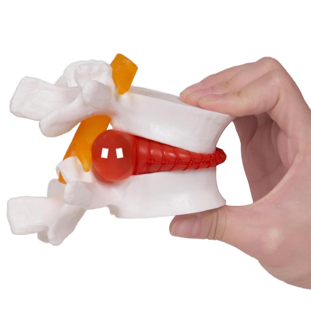 breesky Human Anatomical Lumbar Disc Herniation Model:1.5 Times Life Size Lumbar Disc Teaching Model Tool-for Medical &Teaching & Learning and Scientific Presentations