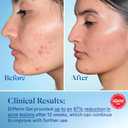 Differin Acne Treatment Gel, 90 Day Supply, Retinoid Treatment for Face with 0.1% Adapalene, Gentle Skin Care for Acne Prone Sensitive Skin, 45g Pump 