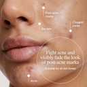 Neutrogena Evenly Clear Acne Gel Moisturizer with Salicylic Acid & N-Acetyl Glucosamine, Lightweight Non-Greasy Face Moisturizer Helps Treat Breakouts & Visibly Fade the look of Post-Acne, 1.7 fl. oz