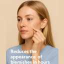 Pimple Patches for Acne (300 Count, 4 Sizes)  Hydrocolloid Zit Stickers with Salicylic Acid, Tea Tree & Calendula  Invisible Overnight Acne Patches for Fast Healing & Clear Skin