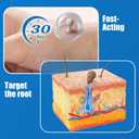 Fast-Acting Skin Tag Remover
