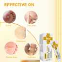 6 x NewX Fast Action Wart Gel Maximum Strength - Wart with Salicylic Acid - Fast-Acting Wart Freeze Off Designed for Warts, Plantar Wart, Genital Wart, Common Wart, Flat Wart, Corn, Callus-G-01