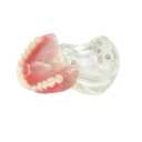 Dental Model Overdenture Inferior 2 Implants Demo Mandibular Model for Education and Study(Upper Jaw)