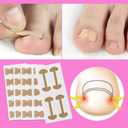 Ingrown Toenail Corrector Set with Correction Strips, Professional Ingrown Toenail Removal Kit, Toenail Correction Strips & Ingrown Toenails Pedicure Tool Set for Home Pedicure Care