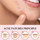 2 x Invisible Acne Patches for Face  Hydrocolloid Acne Patches for Teen Girls & Boys, Best Acne Treatment for Face, Skin Care Stocking Stuffers for Teens, Women & Adults, Invisible Zit Patch