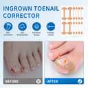 2 x Ingrown Toenail Removal Kit - 50 Pcs Pain-Free Ingrown Toenail Corrector Strips with Toe Nail Lifter Painless File - Easy Use Ingrown Toenail Tools Kit