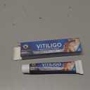 Vitiligo Cream, Natural Vitiligo Treatment Cream, Suitable for Skin Vitiligo, Pigmentation & Leukoplakia, Restore Skin Tone, for Men & Women