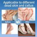 Callus Remover for Feet, Electric Foot Callus Remover Waterproof with 3 Rollers 2 Speed Battery Display,17 in1 Rechargeable Foot File Pedicure Kits for Dead Hard Cracked Dry Skin