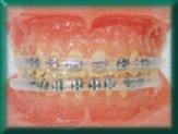 Morgan Bumper Braces Cover Lip Protector for Orthodontic Patients - Clear - Qty 2