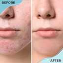 Cystic Acne Spot Treatment, Overnight Hormonal Cystic Acne Treatment for Face, Women, Men and Teens, Cystic Hormonal Acne Treatment for Body, Pimple Cream, Sulfur Acne Spot Treatment, 120 Uses