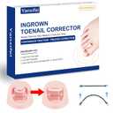 Nitinol Ingrown Toenail Corrector,at Home Ingrown Toenail Treatment,Curved Toenail Straightener,Ingrown Toe Nail ReliefIngrown Toenail Removal Kit (11/16 In,13/16 In)