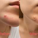 2 x Invisible Acne Patches for Face  Hydrocolloid Acne Patches for Teen Girls & Boys, Best Acne Treatment for Face, Skin Care Stocking Stuffers for Teens, Women & Adults, Invisible Zit Patch