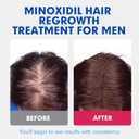 Fytikal 5% Minoxidil for Men Hair Regrowth Treatment, Extra Strength Topical Solution for Thinning Hair & Balding, Beard Growth Enhancer, Non-Greasy Fast-Absorbing Formula, 3-Month Supply