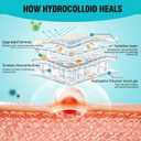 Hydrocolloid Roll for Wound Care, Large Hydrocolloid Patch Bandages with Self-Adhesive, Bed Sore Bandages, Highly Absorbent for Burn, Blister, Acne Care, Sterile and Waterproof (2in x 10ft)