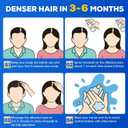 5% Minoxidil for Men and WomenMinoxidil hair growth productsIntense Hair Growth SerumMay Promote Faster, Stronger, Thicker Hair Growth to Fight Hair Loss and Thinning Hair2.82 oz*2)
