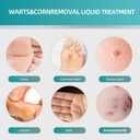 Wart Remover Liquid with Salicylic Acid for Wart Removal & Corn Care, Targeted Application, 1.01 Fl Oz