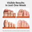 2 x modelones Toenail Fungus Treatment Extra Strength 7days Nail Fungus Treatment for Toenail and Fingernail With Brushes Head Nail Repair for Damaged Nails Antifungal Nail Polish 30ML 1Fl Oz