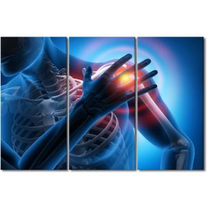 Contemporary Wall Decor Human Shoulder Pain Skeleton X-Ray Pictures Artwork Wall Art for Living Room 3 Piece Medical Health Care Concept Poster Modern Artwork Painting Framed Ready to Hang 40"Wx60"H