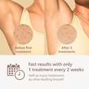 Philips Lumea 9000 Series IPL Hair Removal Device, Visible Permanent Laser Hair Reduction Done at Home, for Women & Men, SenseIQ Technology, 4 Attachments for Body, Face, Bikini & Underarms, BRI984/03