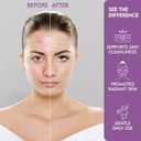 Hydrocolloid Full Face Acne Patches  10 PCS Large Zit Stickers for Chin, Nose, Forehead & Cheeks  Oil Absorbing Hydrocolloid Pimple Patches for All Skin Types  Gentle, Invisible