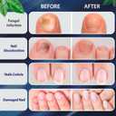 Tobcharm Toenail Fungus Treatment : Nail Fungus Treatment Extra Strength with Tea Tree Oil - Fast Acting Fungal Nail Solution with Undecylenic Acid for Toenails and Fingernails (2pack, 1fl oz each)