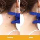 6 x NewX Fast Action Wart Gel Maximum Strength - Wart with Salicylic Acid - Fast-Acting Wart Freeze Off Designed for Warts, Plantar Wart, Genital Wart, Common Wart, Flat Wart, Corn, Callus-G-01