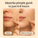 Pimple Patches for Acne (300 Count, 4 Sizes)  Hydrocolloid Zit Stickers with Salicylic Acid, Tea Tree & Calendula  Invisible Overnight Acne Patches for Fast Healing & Clear Skin