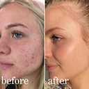 Mandelic Acid Serum Toner Exfoliant | Great For Acne Breakouts, Reduce Redness, Balancing Treatment | Plus Niacinamide, Licorice Root & Hyaluronic Acid, Hydration (Lissy Skincare)