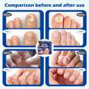 2Pack Multi-Purpose Nail Repair, Nail Solution with Tea Tree Oil for Discolored and Damaged Nails Plant Drops for Nails Care Discolored and Damaged Nails (1PCS)