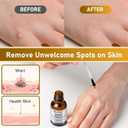 "STAY STOKED" Wart Remover, 15ml Fast-Acting Wart Freeze Off Liquid - The Strongest Wart Remover for Feet, Clinically Proven to Eliminate Stubborn Warts Resistant, Quick-Drying for Daily Use-H5520