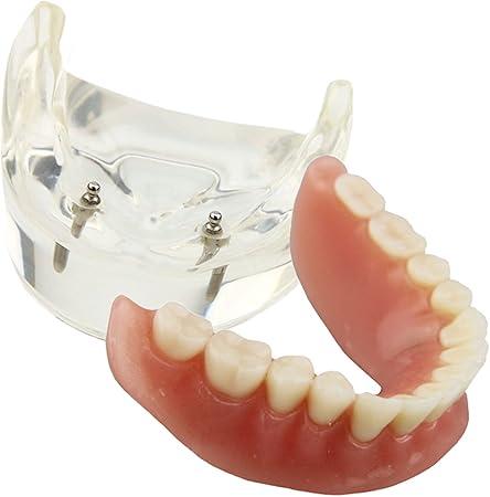 Dental Model Overdenture Inferior 2 Implants Demo for Studying and Teaching
