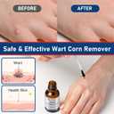 SKAYAH Wart Remover Freeze Off - Professional Strength Wart Remover Liquid - 5% Salicylic Acid Fast-Acting Treatment for Plantar Wart,Flat Wart, Corn and Callus Remover, 15ml (0.5 fl oz)-H236