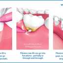 Piksters Interdental Brushes, 40 pk, Size 00, Interdental Tooth Brush for Extremely Tight Gaps, Gum Soft Bristles for Plaque Removal, Safe for Braces (40 Count (Pack of 1))