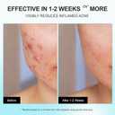 Acne Pimple Spot Treatment Cream: Cystic Hormonal Breakouts Control for Face & Back - 2% Salicylic Acid, Fast Redness Relief, Fades Blemishes & Post-Acne Marks, Teens-Adults, 1.8 oz