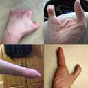 active hands Limb Difference Aid for Gripping in Gym/Home with Missing Fingers/Hand Parts