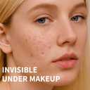 Pimple Patches for Acne (300 Count, 4 Sizes)  Hydrocolloid Zit Stickers with Salicylic Acid, Tea Tree & Calendula  Invisible Overnight Acne Patches for Fast Healing & Clear Skin