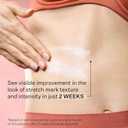 StriVectin SD Advanced Plus Intensive Moisturizer for Wrinkles and Stretchmarks, For Face and Body, Collagen Boosting with Peptides and Hyaluronic Acid (4 Ounce (Pack of 1))