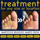 3 x Wart Remover Propolis Infused Wart Removal Stick with 40% Salicylic Acid | Treats Stubborn Warts on Hands, Feet & Body | Painless, Fast Acting, Maximum Strength | Portable & Easy to Apply 10 g