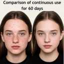 Ozone Plasma Facial Wand  Deep Pore Cleansing Skincare Device for Sensitive Skin with Collagen Boost Cold Compress and Soothing Massage for Daily Face Routine